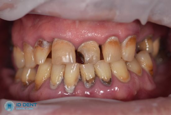 фото перед проведением профессиональной гигиены зубов