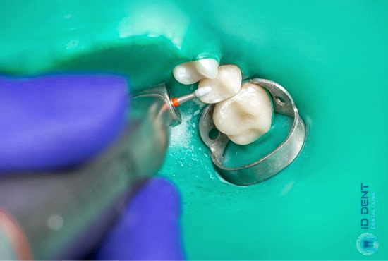 Лікування глибокого карієсу шляхом препарування уражених тканин зуба