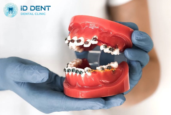 Застосування міні-імплантів в процесі ортодонтичного лікування