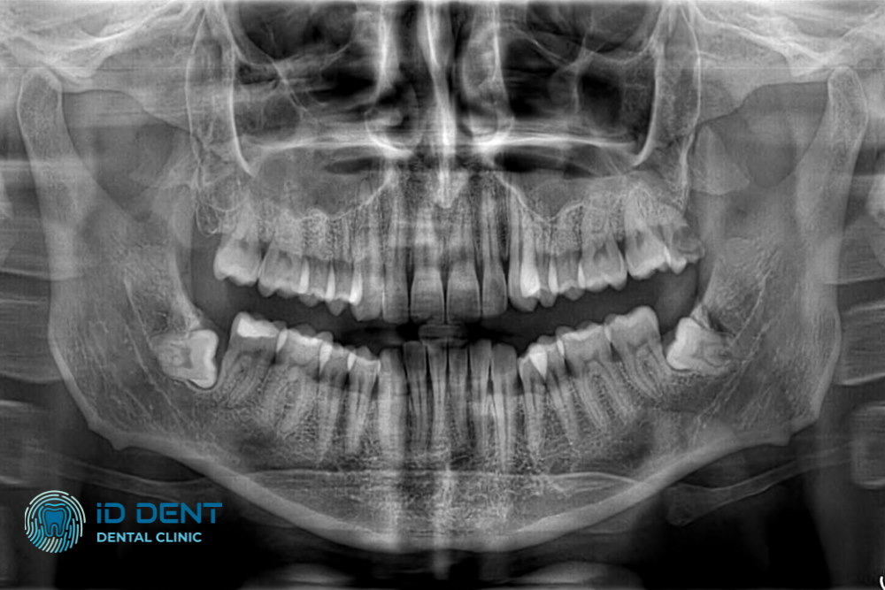  Рентгенодиагностика зубов
