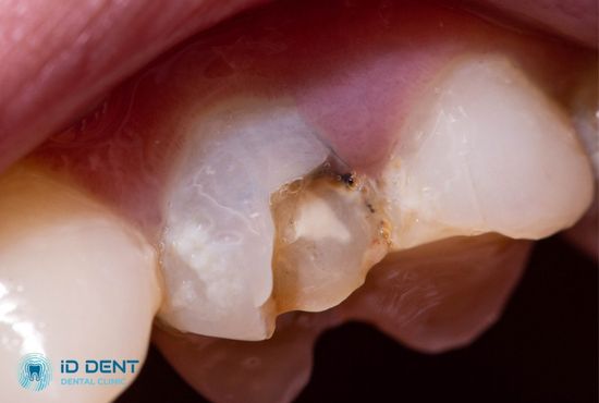 Карієс на зубах як показання до їх реставрації