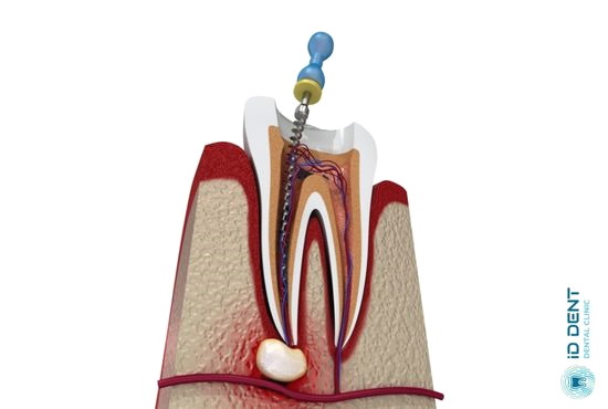 Процесс лечения каналов зуба