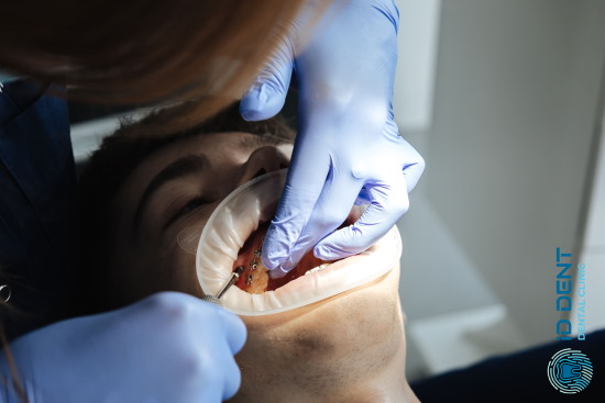Встановлення ортодонтичного міні-імпланту