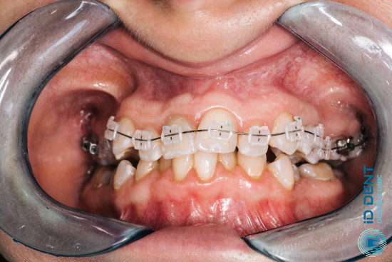 Виправлення скупченості зубів за допомогою керамічних брекетів