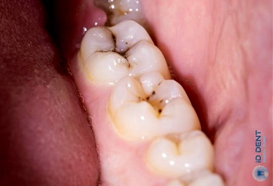 Темные кариозные пятна на зубах
