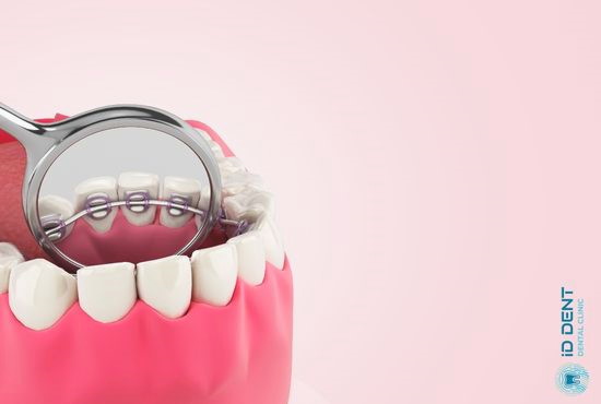 Внутрішня непомітна брекет-система на зуби