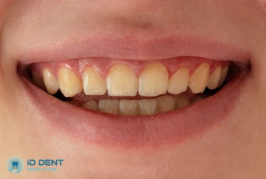 Желтизна зубов - показание к винирам