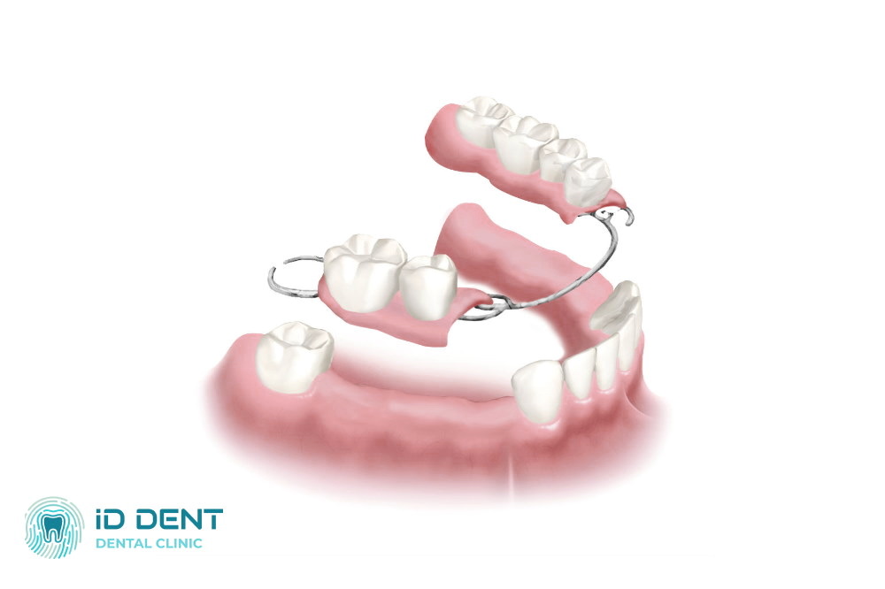 Prótesis dentales esqueléticas