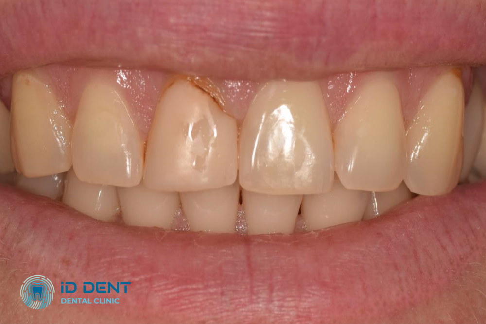 Antes Carillas de porcelana para los dientes