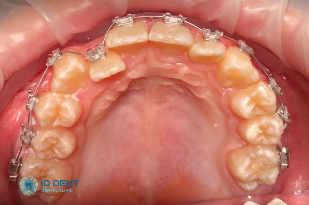 Antes Alineación dental
