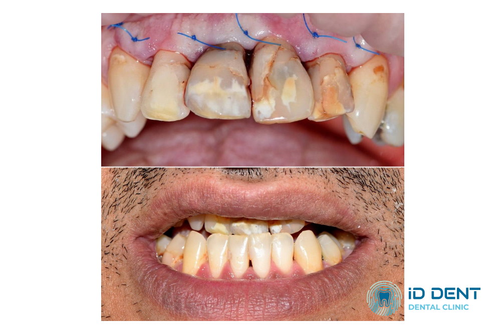 Antes Coronas dentales de circonio