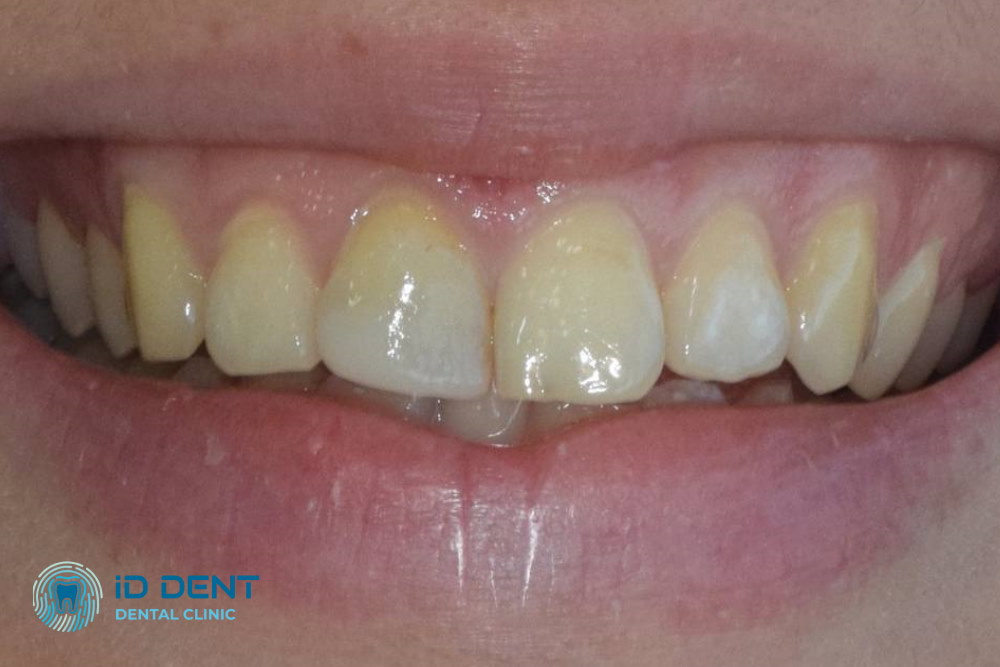 Antes  Carillas dentales