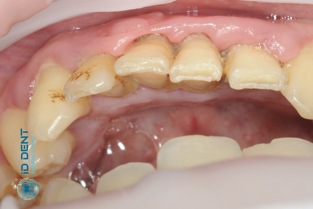 Antes  Tratamiento de la gingivitis