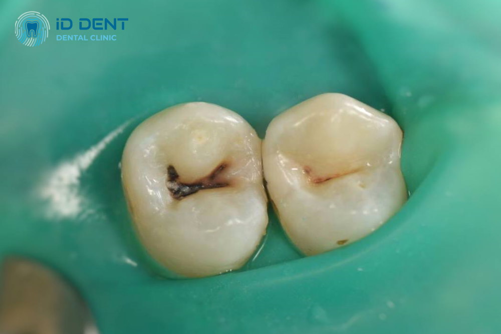 Antes  Tratamiento de caries