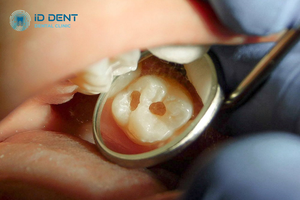 Antes Tratamiento dental