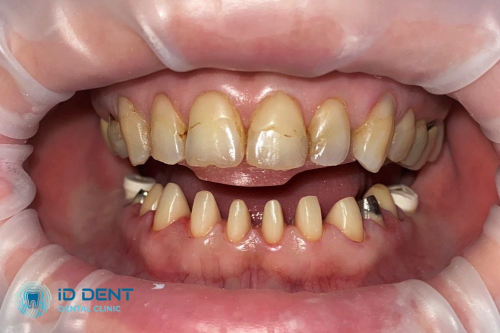 Antes  Coronas dentales