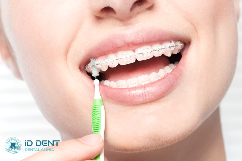 Brackets de cerámica