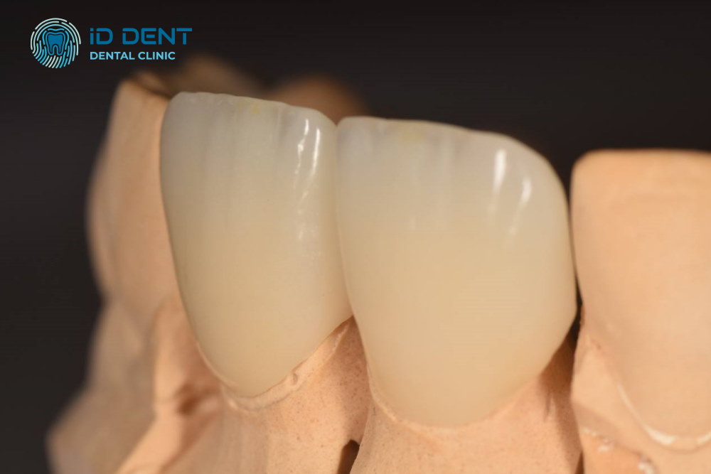 Coronas de cerámica