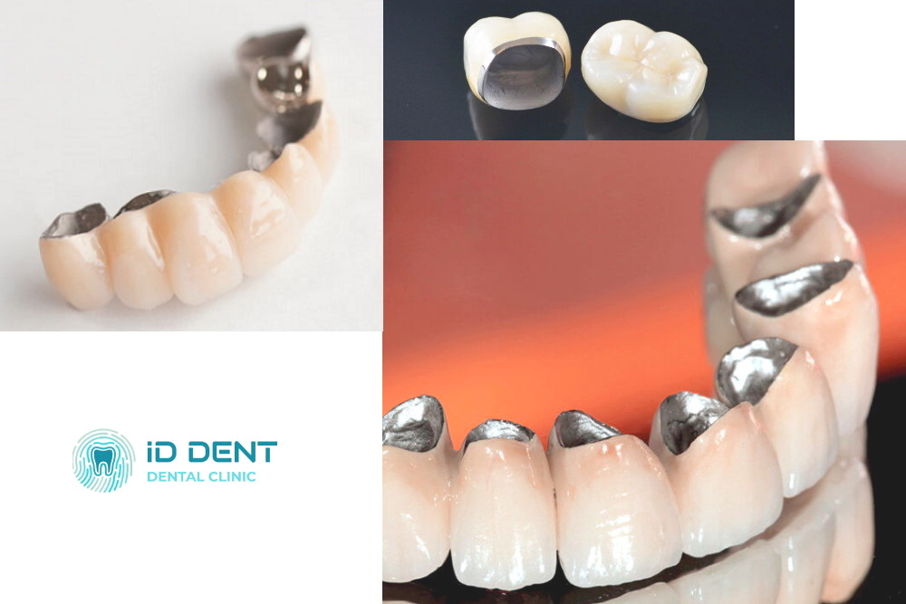 Corona de metal-cerámica