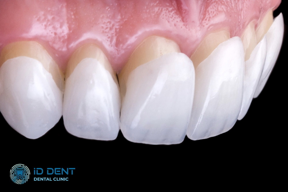 Carillas de composite para los dientes