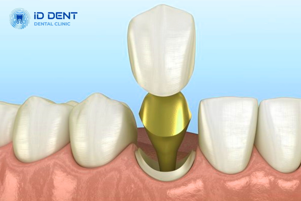 Incrustación radicular