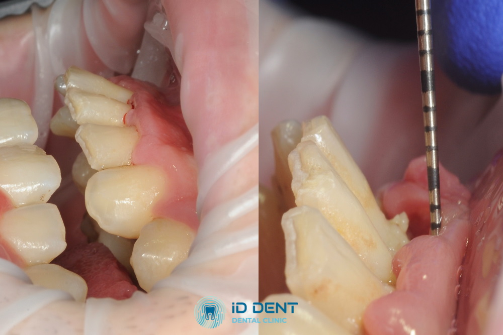 Tratamiento de la periodontitis