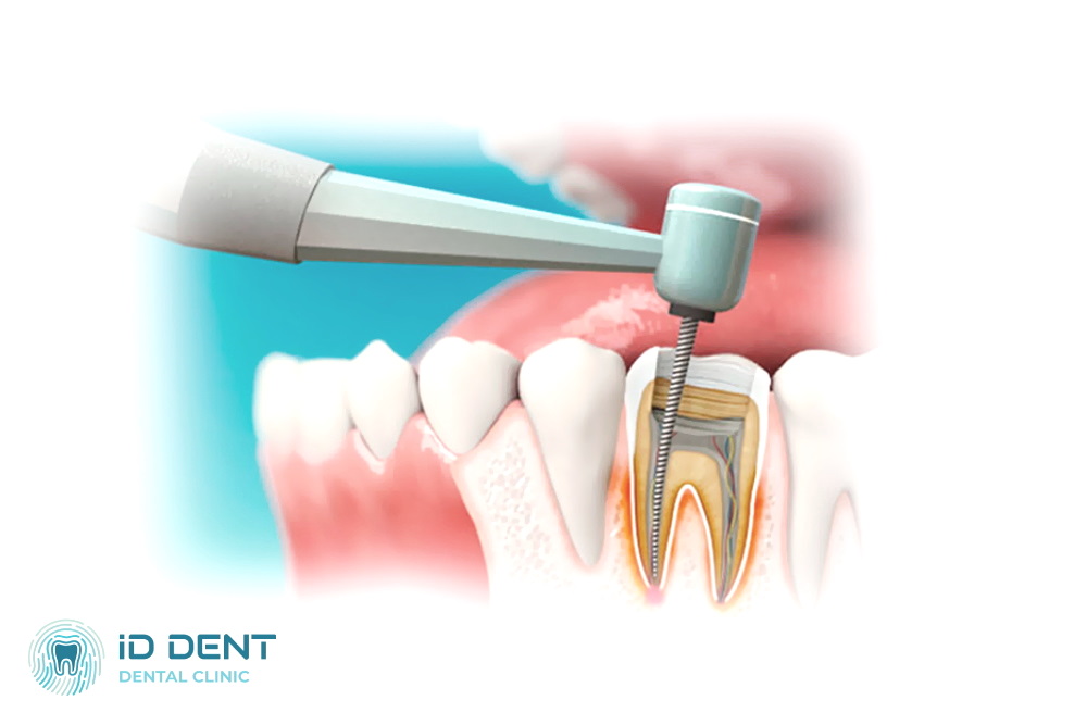 Tratamiento de la periodontitis