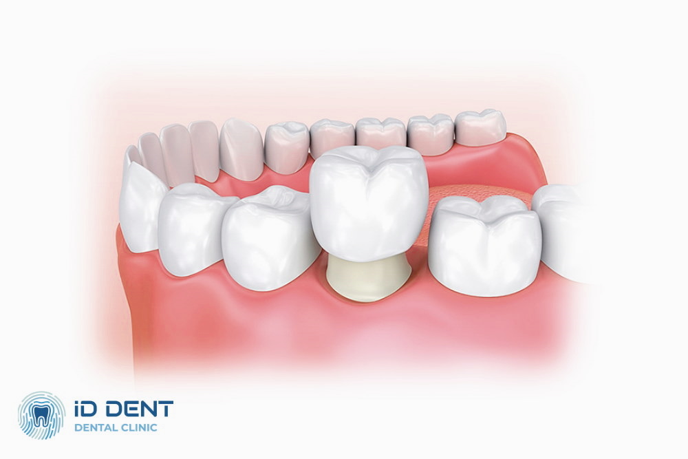 Prótesis dental fija