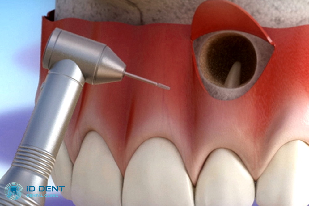 Resección de la punta de la raíz