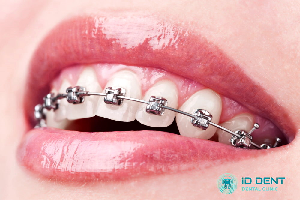 Brackets autoligables (sin ligaduras)