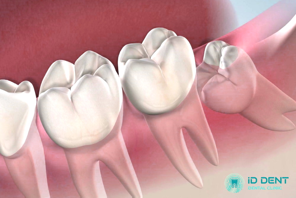 Extracción de las muelas del juicio