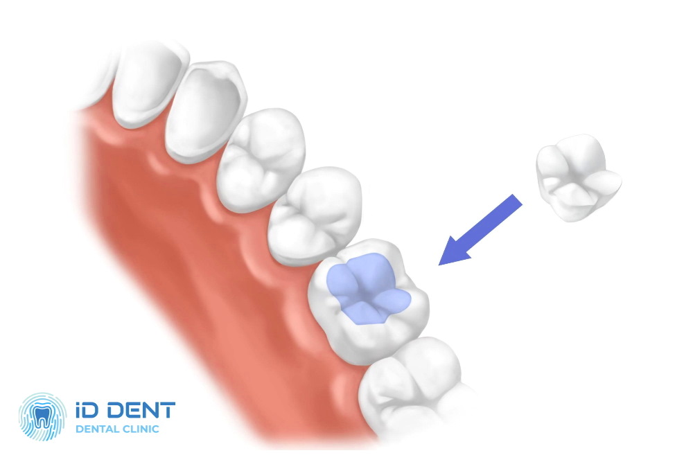 Incrustaciones dentales