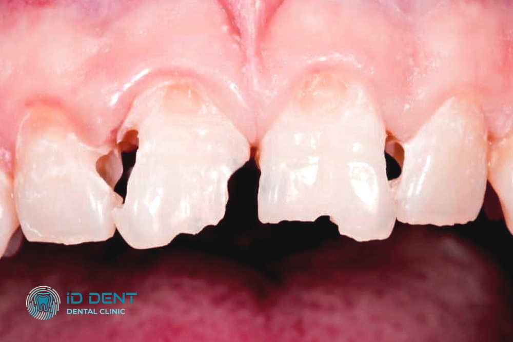 Antes  Restauración dental estética