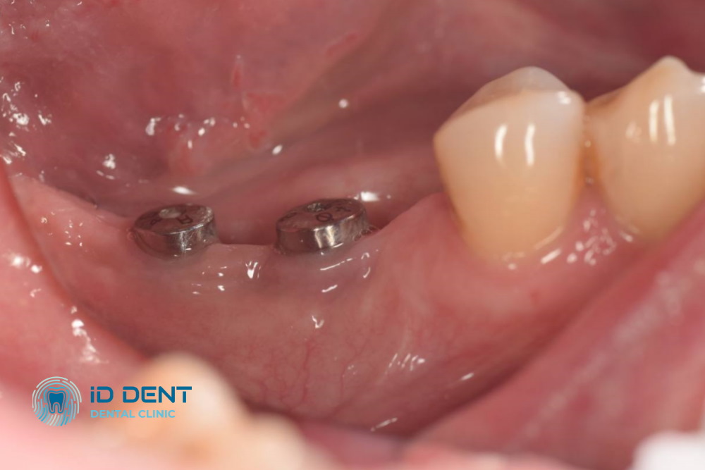 Antes Prótesis sobre implantes