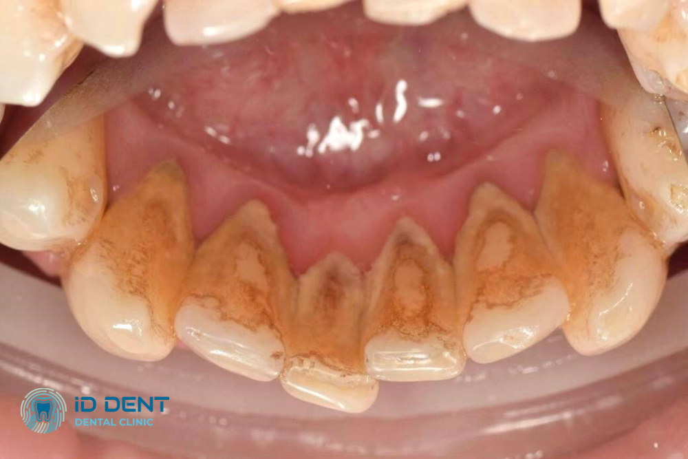 Antes Limpieza dental