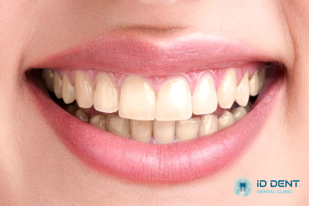 Antes Blanqueamiento dental