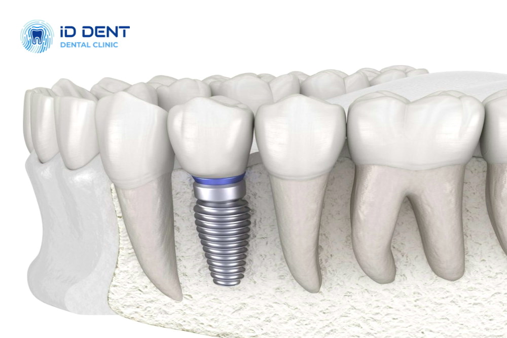 Implantación dental