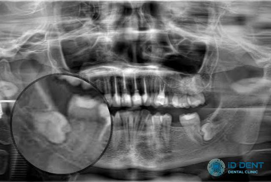 Атипове розміщення зуба як показання до його видалення уві сні