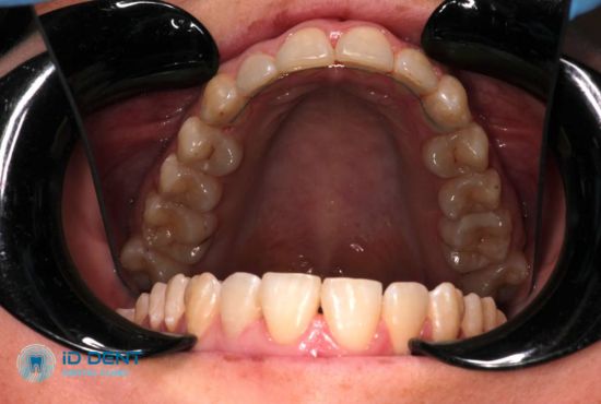 Фото результата выравнивания зубного ряда с помощью брекетов