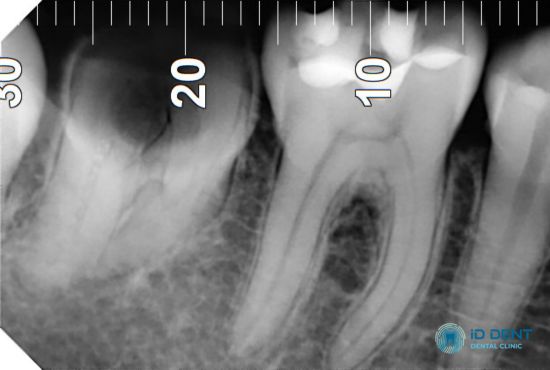 Рентген одного зуба