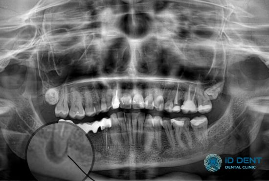 Рентгенодіагностика гранульоми зуба