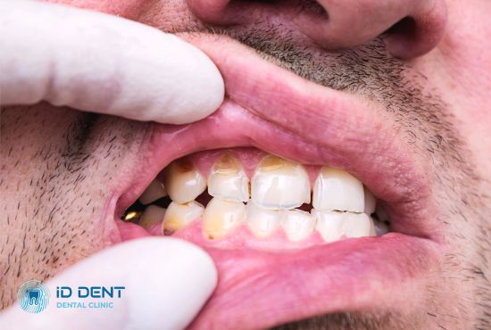 Внешние признаки разрушения зубной эмали