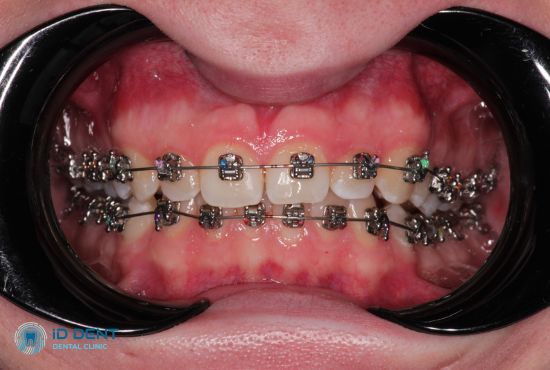Зовнішній вигляд металевих брекетів для вирівнювання зубів