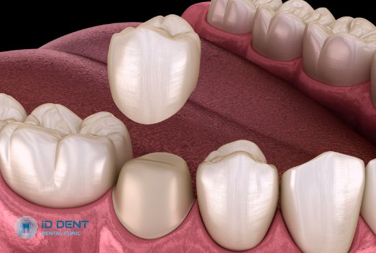 Защита обработанного зуба с помощью временной коронки