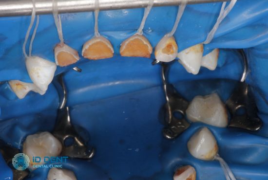 Фото до лікування молочних зубів