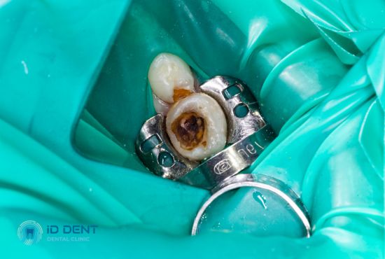 Фото до пломбування постійного зуба у стоматології id dent
