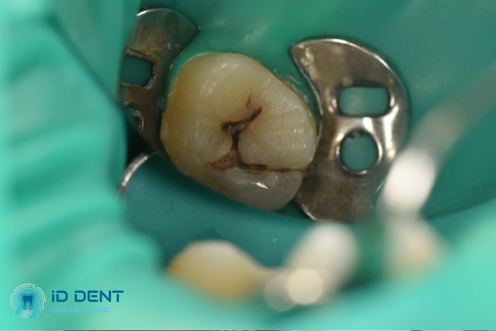 Antes  Tratamiento de caries media