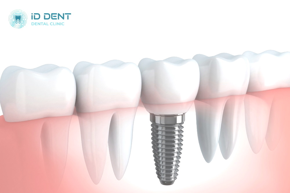  Implantes Osstem