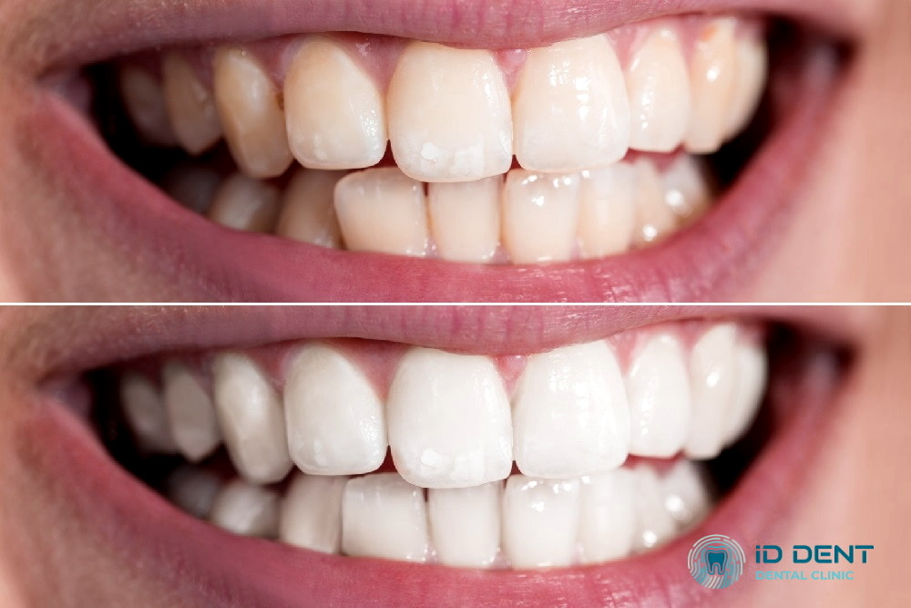 Férulas para el blanqueamiento dental