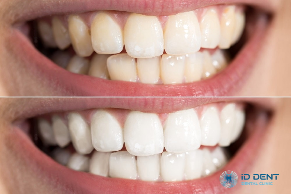 Blanqueamiento dental Beyond
